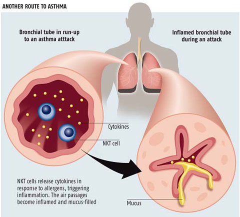 asthma diagram