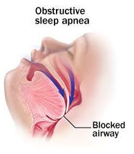 obstructive sleep apnea airway diagram